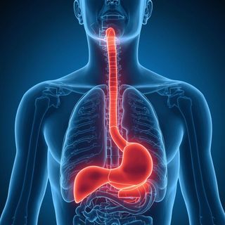 Esophagitis Caused by Gastroesophageal Reflux